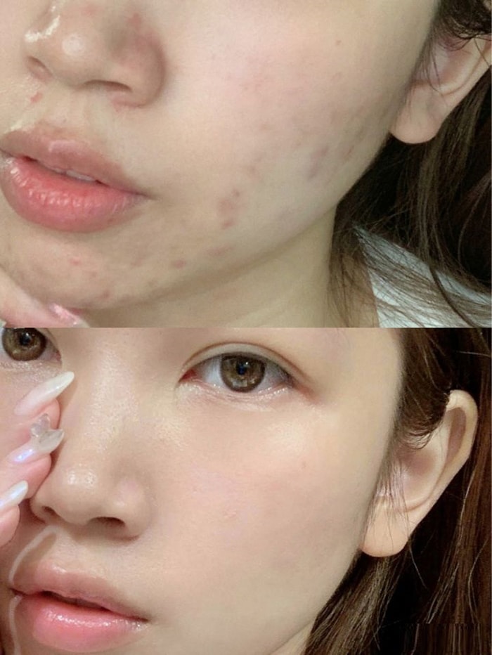 Da mặt trước và sau khi sử dụng trị mụn goldskin
