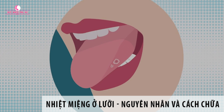 Nhiệt miệng ở lưỡi - Nguyên nhân và cách chữa trị hiệu quả