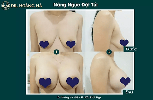 Ưu điểm nổi bật khi nâng ngực tại Dr Hoàng Hà